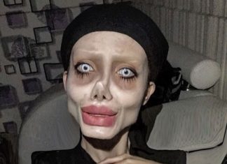 Stravična, tužna priča o djevojci koja je htjela je izgledati kao Angelina Jolie, a sad je uništena lica i zdravlja još i koronična na respiratoru